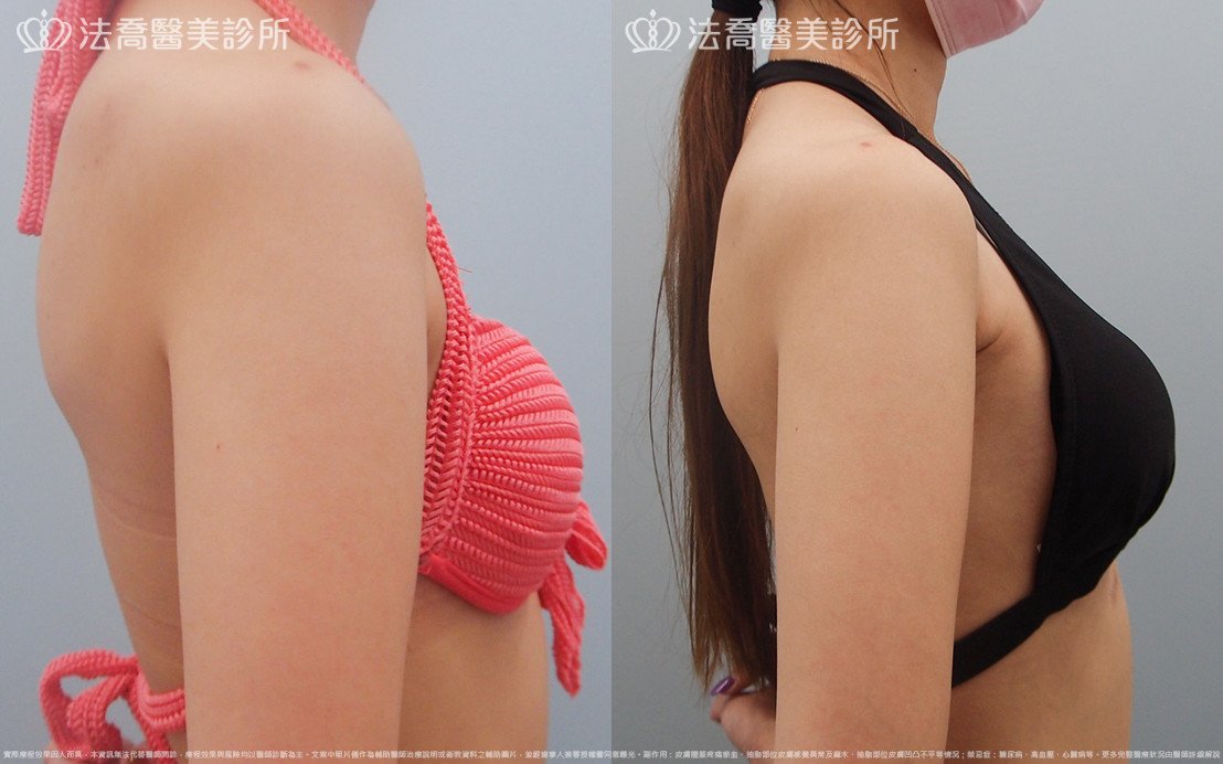 法喬醫美診所,邱浚彥,水滴果凍隆乳