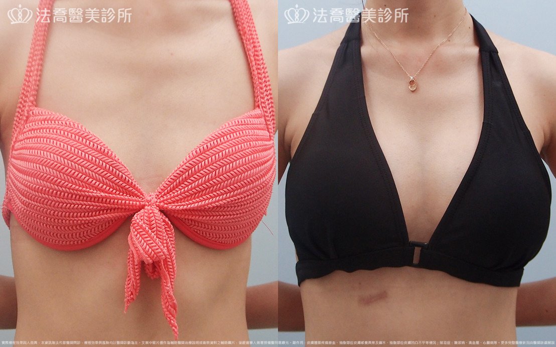 法喬醫美診所,邱浚彥,水滴果凍隆乳