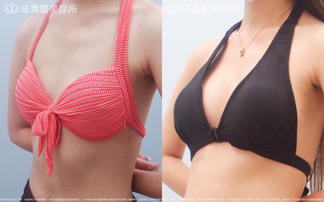 法喬醫美診所,邱浚彥,水滴果凍隆乳