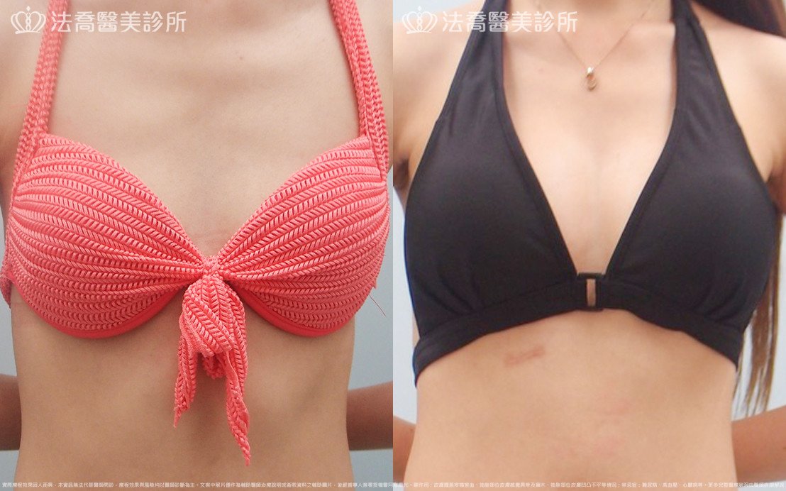 法喬醫美診所,邱浚彥,水滴果凍隆乳