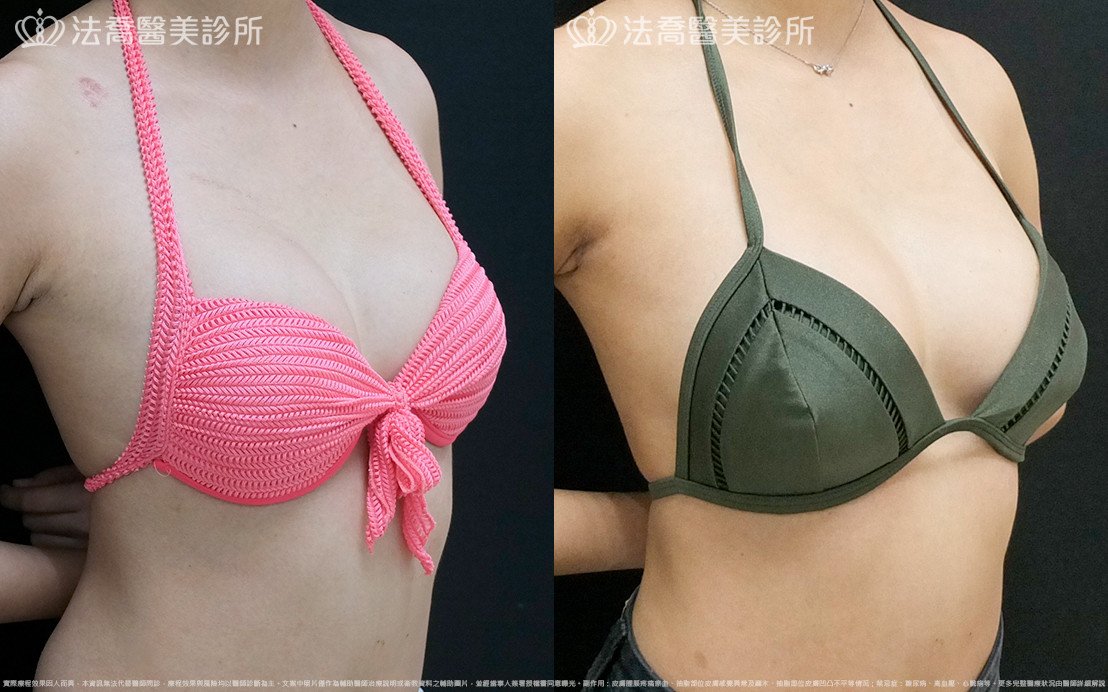 法喬醫美診所,邱浚彥,水滴果凍隆乳