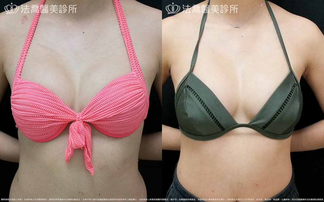 法喬醫美診所,邱浚彥,水滴果凍隆乳