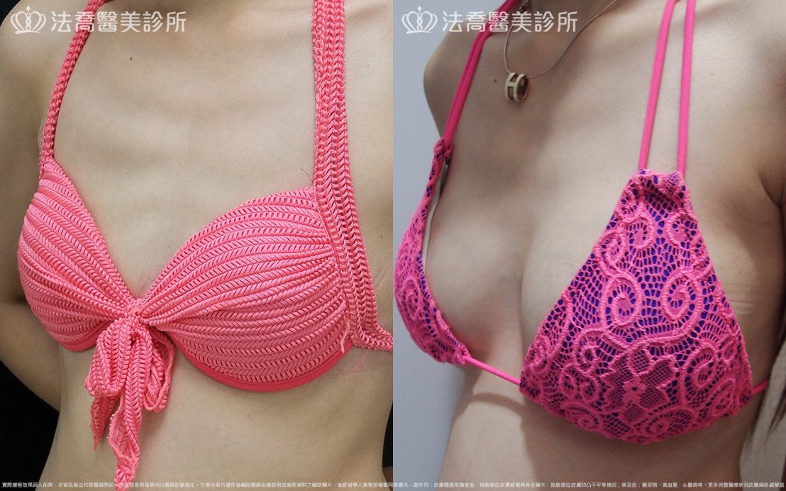 法喬醫美診所,邱浚彥,水滴果凍隆乳