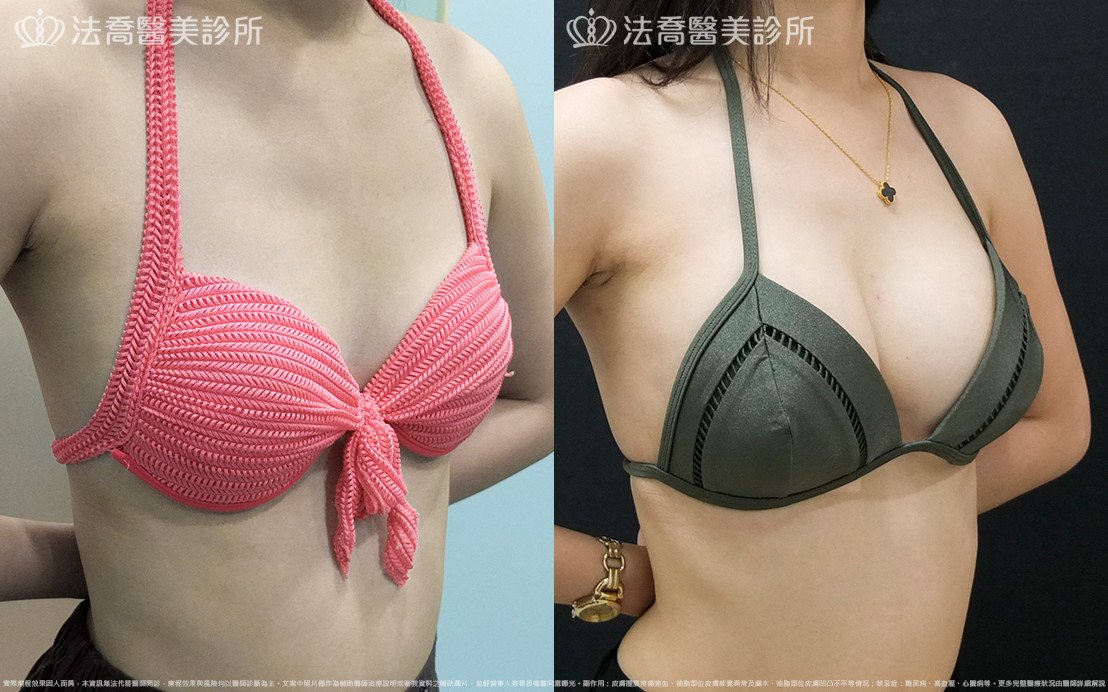 法喬醫美診所,邱浚彥,水滴果凍隆乳