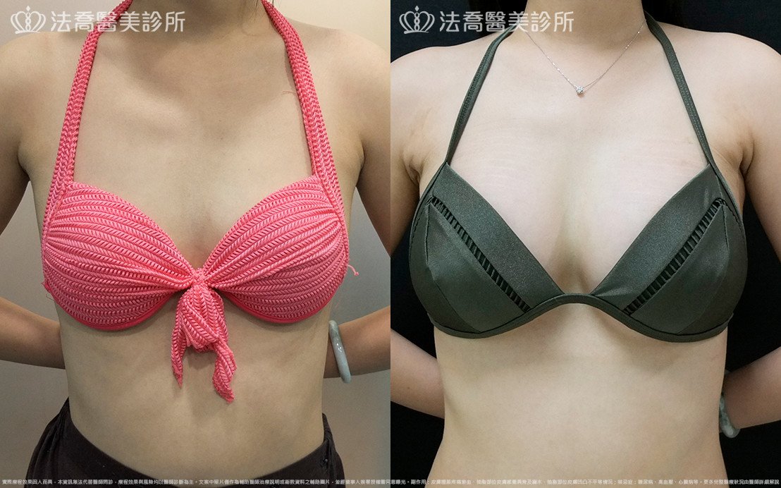 法喬醫美診所,邱浚彥,水滴果凍隆乳