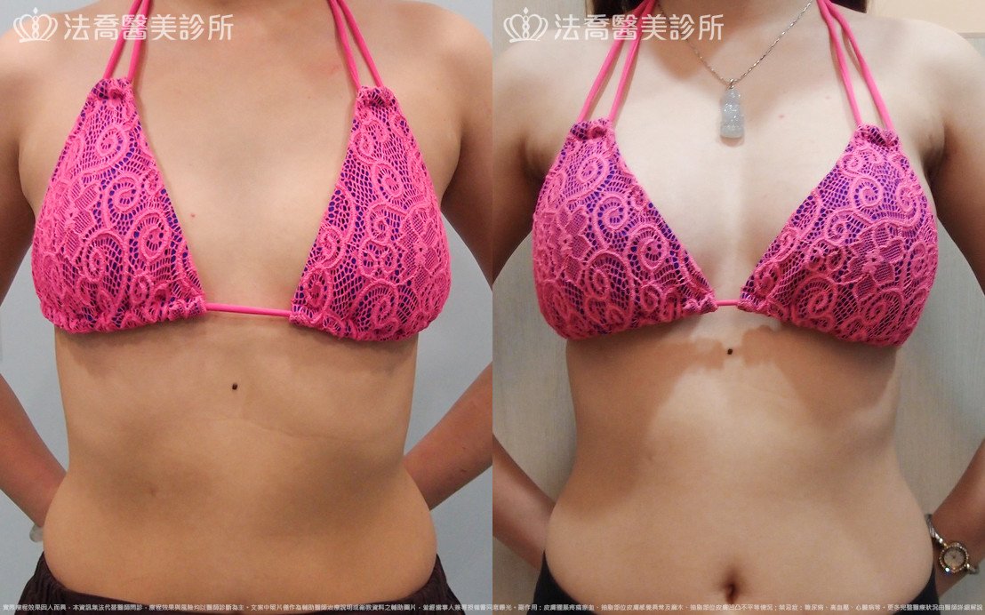 法喬醫美診所,邱浚彥,水滴果凍隆乳