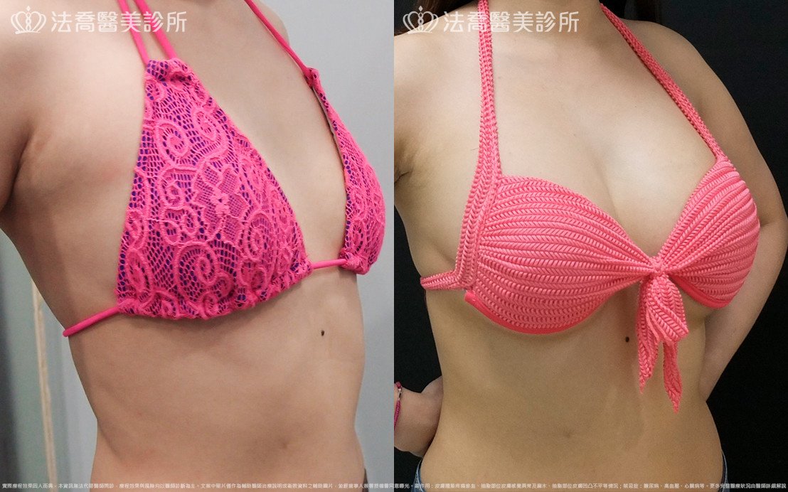 法喬醫美診所,邱浚彥,水滴果凍隆乳