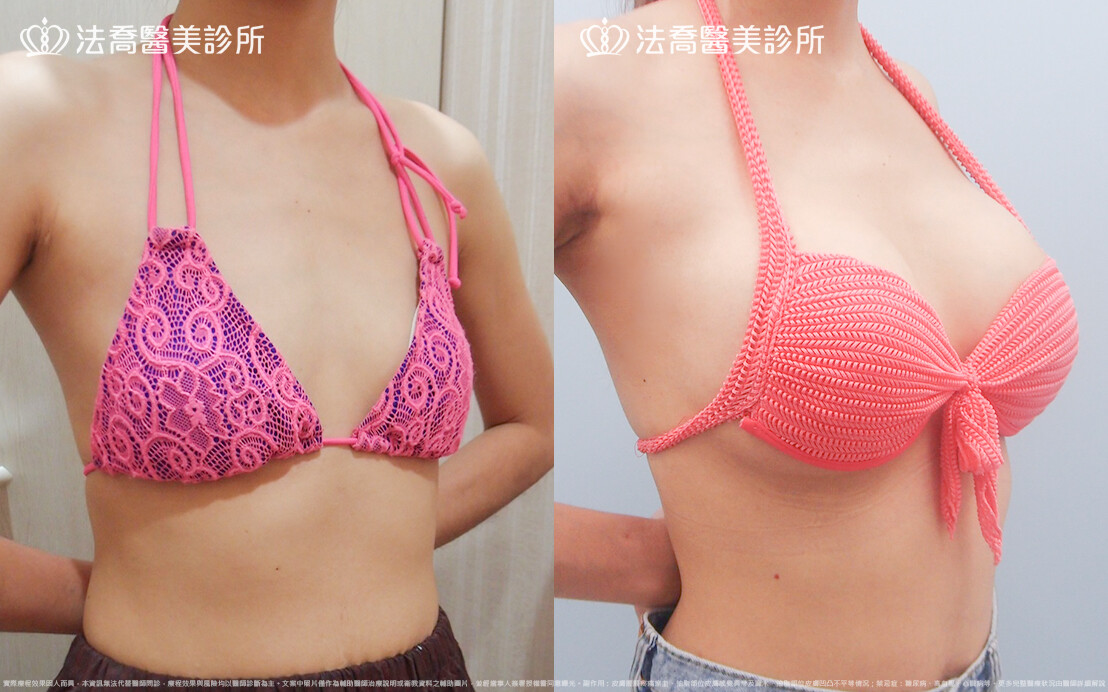 法喬醫美診所,邱浚彥,水滴果凍隆乳