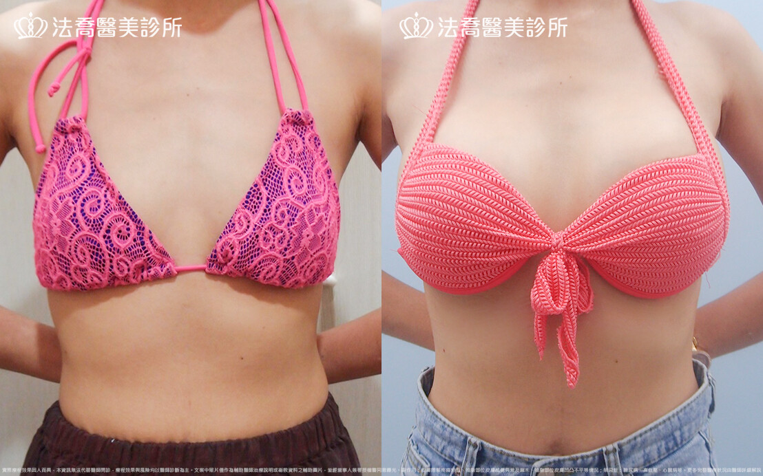 法喬醫美診所,邱浚彥,水滴果凍隆乳