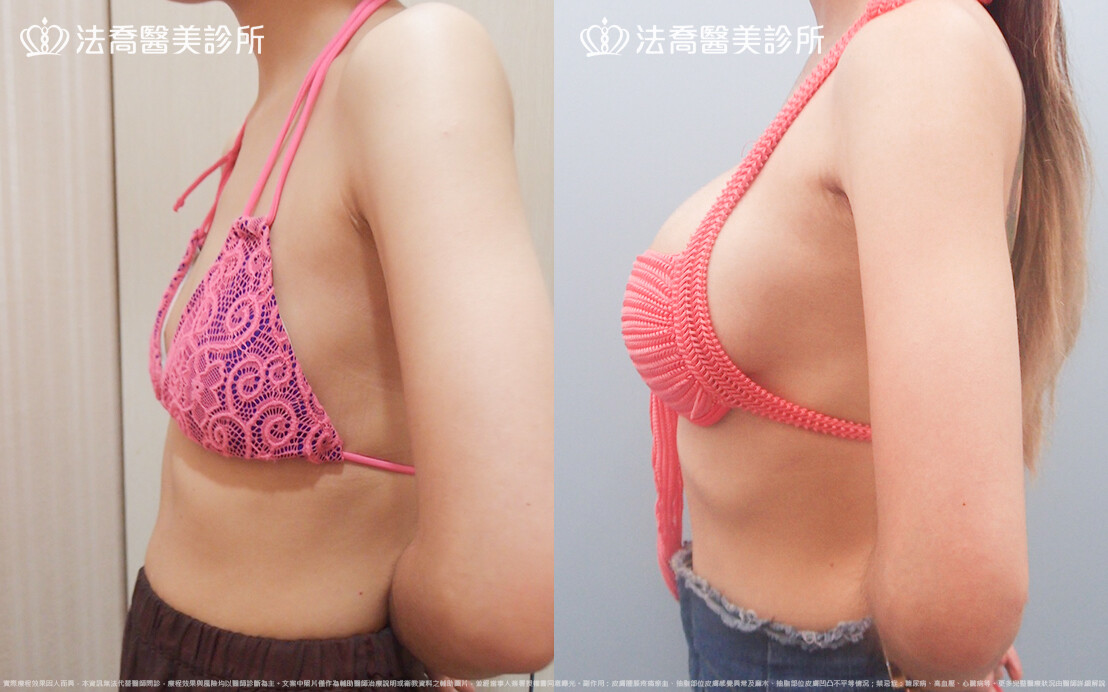 法喬醫美診所,邱浚彥,水滴果凍隆乳