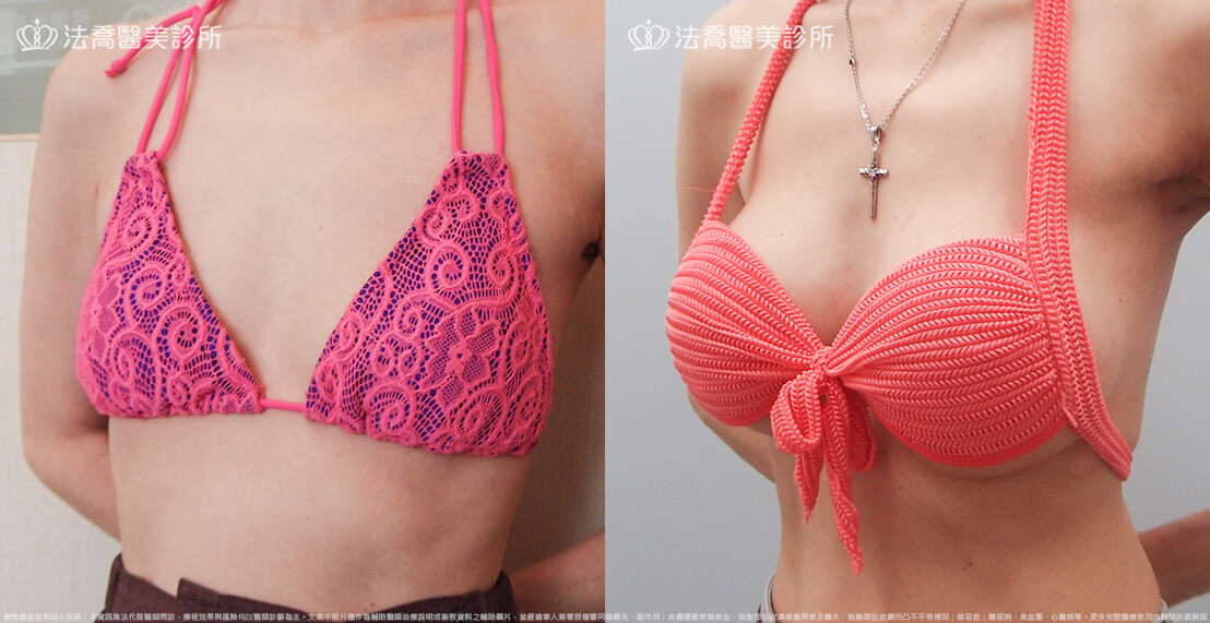 法喬醫美診所,邱浚彥,水滴果凍隆乳