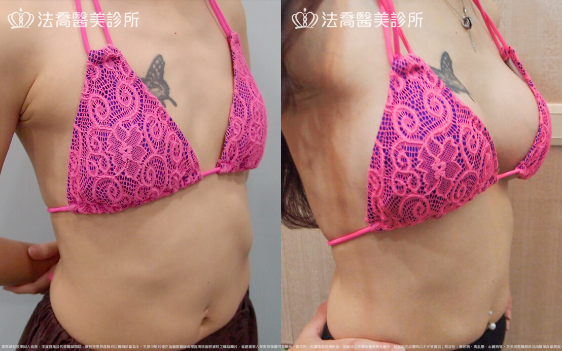 法喬醫美診所,邱浚彥,水滴果凍隆乳