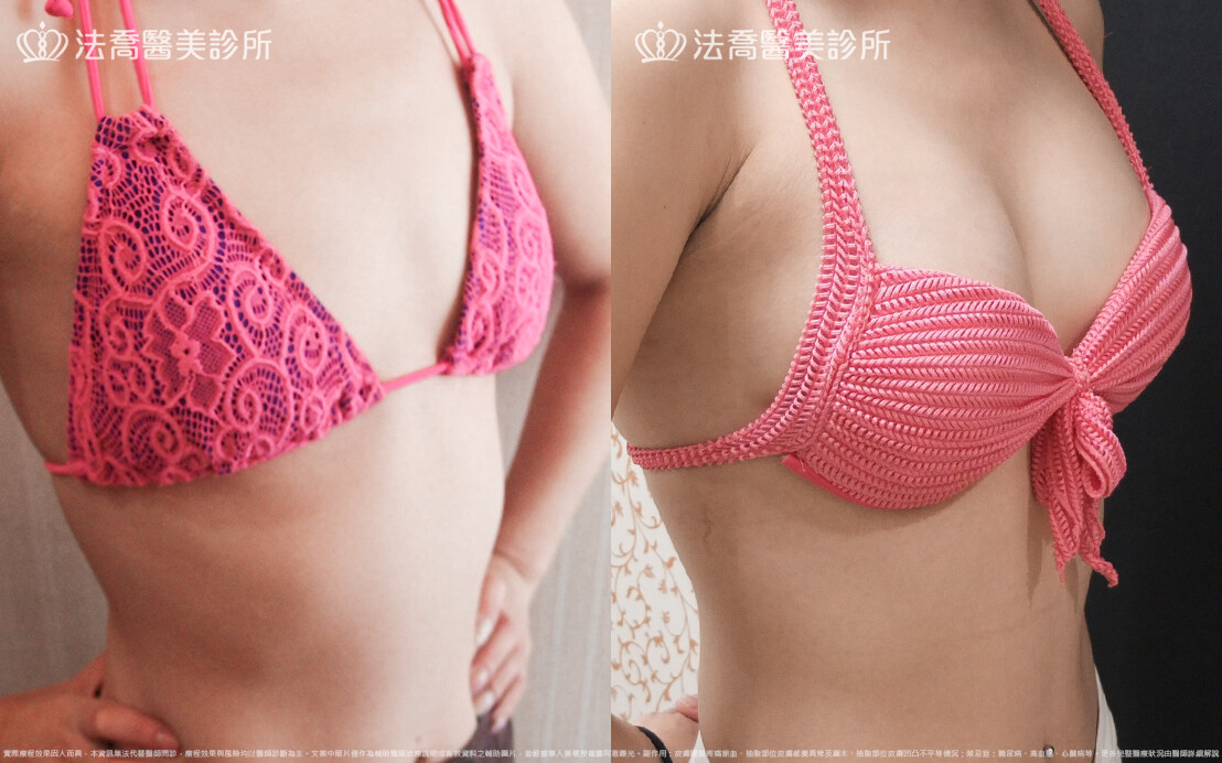 法喬醫美診所,邱浚彥,水滴果凍隆乳