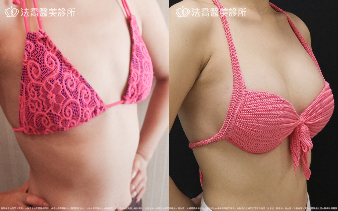 法喬醫美診所,邱浚彥,水滴果凍隆乳