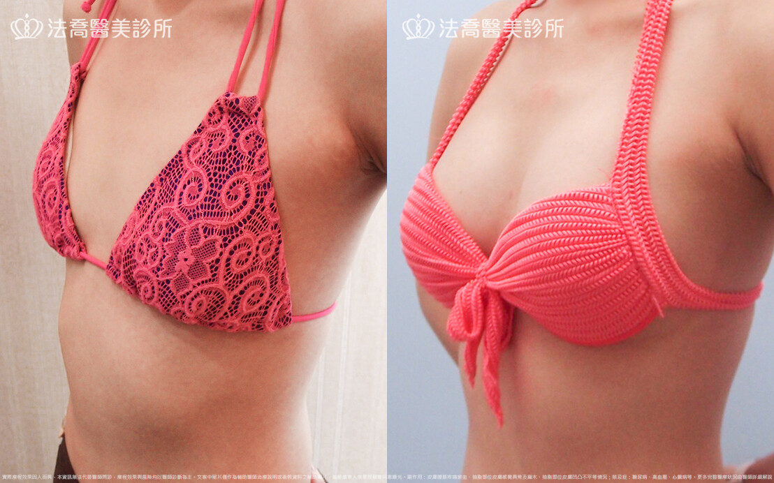 法喬醫美診所,邱浚彥,水滴果凍隆乳