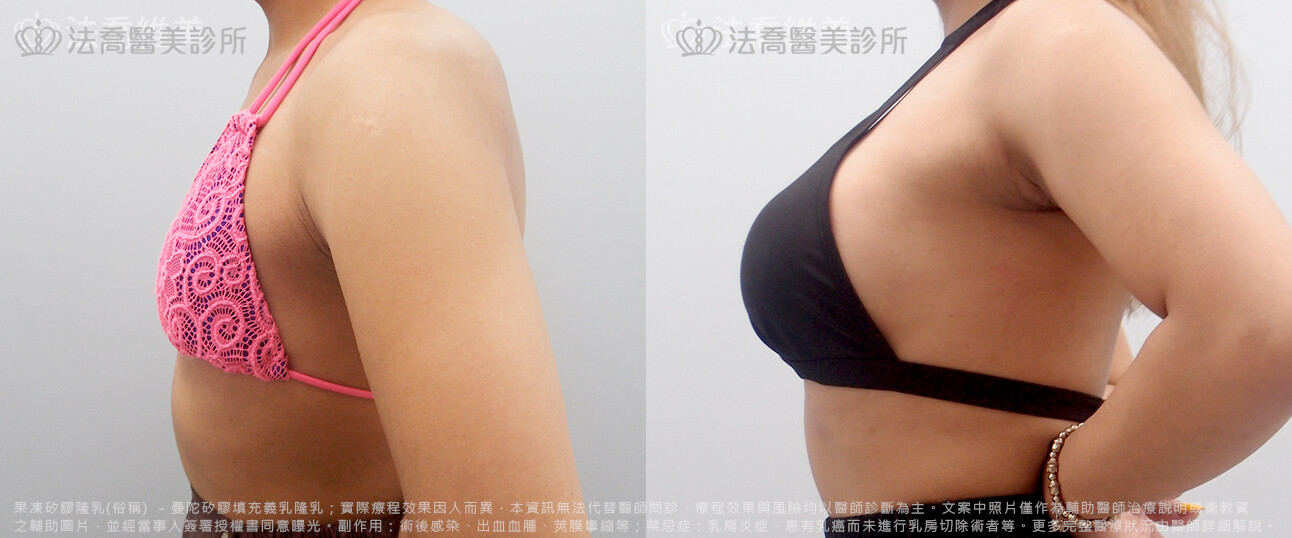 法喬醫美診所,邱浚彥,水滴果凍隆乳