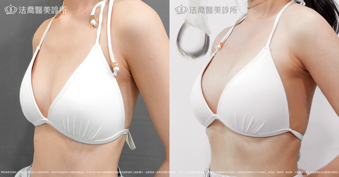 法喬醫美診所,邱浚彥,魔滴隆乳