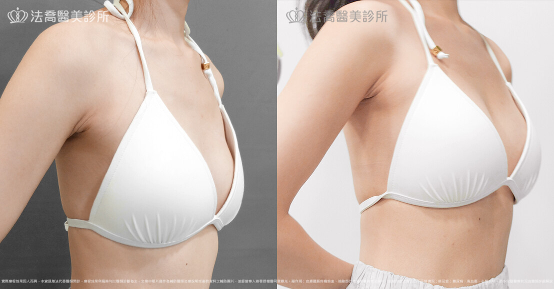 法喬醫美診所,邱浚彥,魔滴隆乳