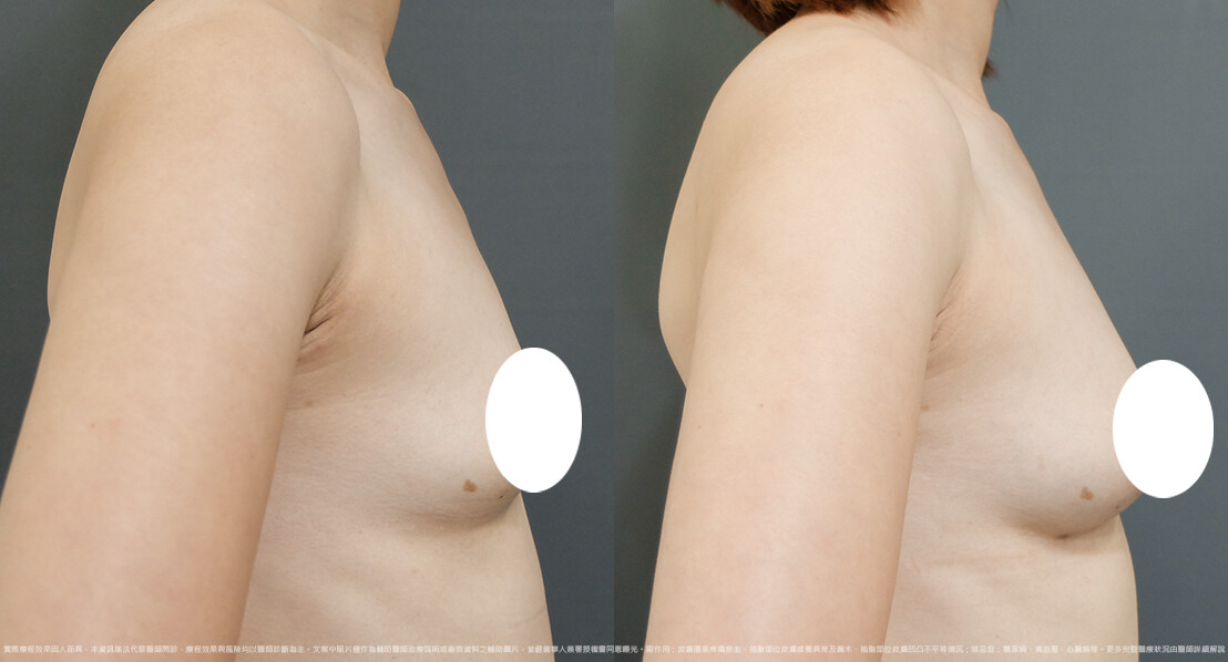 豐胸 