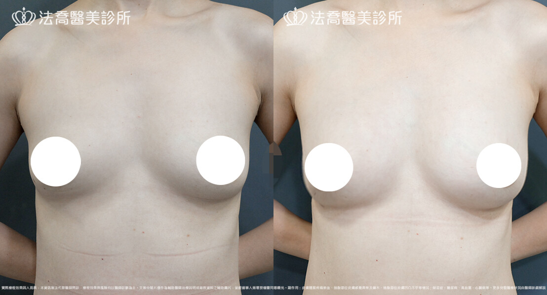 自體脂肪豐胸 