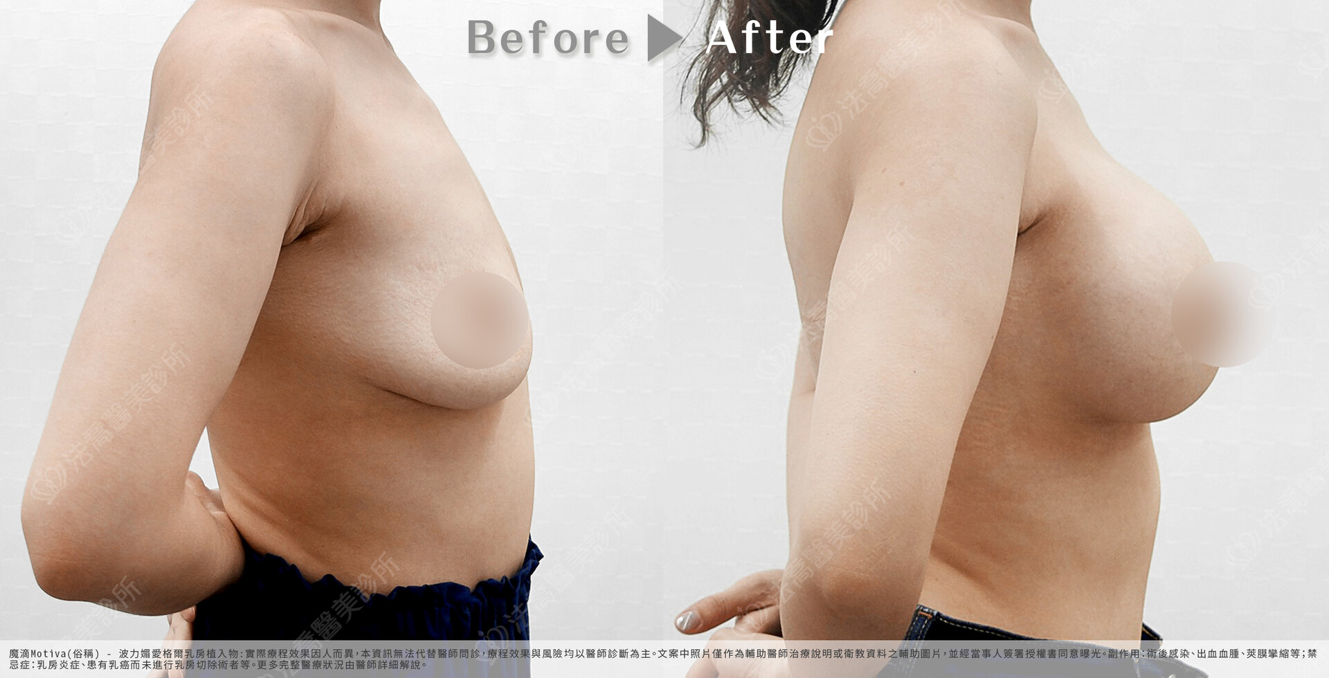 法喬醫美診所,魔滴隆乳