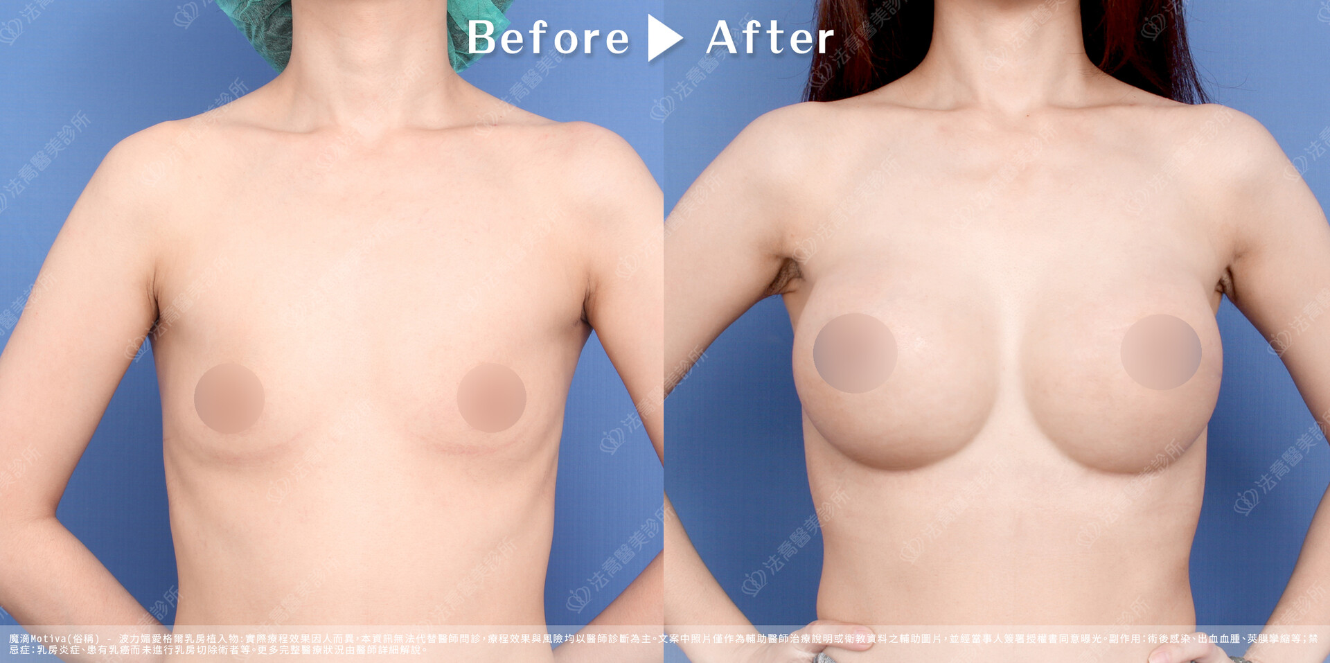 法喬醫美診所,魔滴隆乳