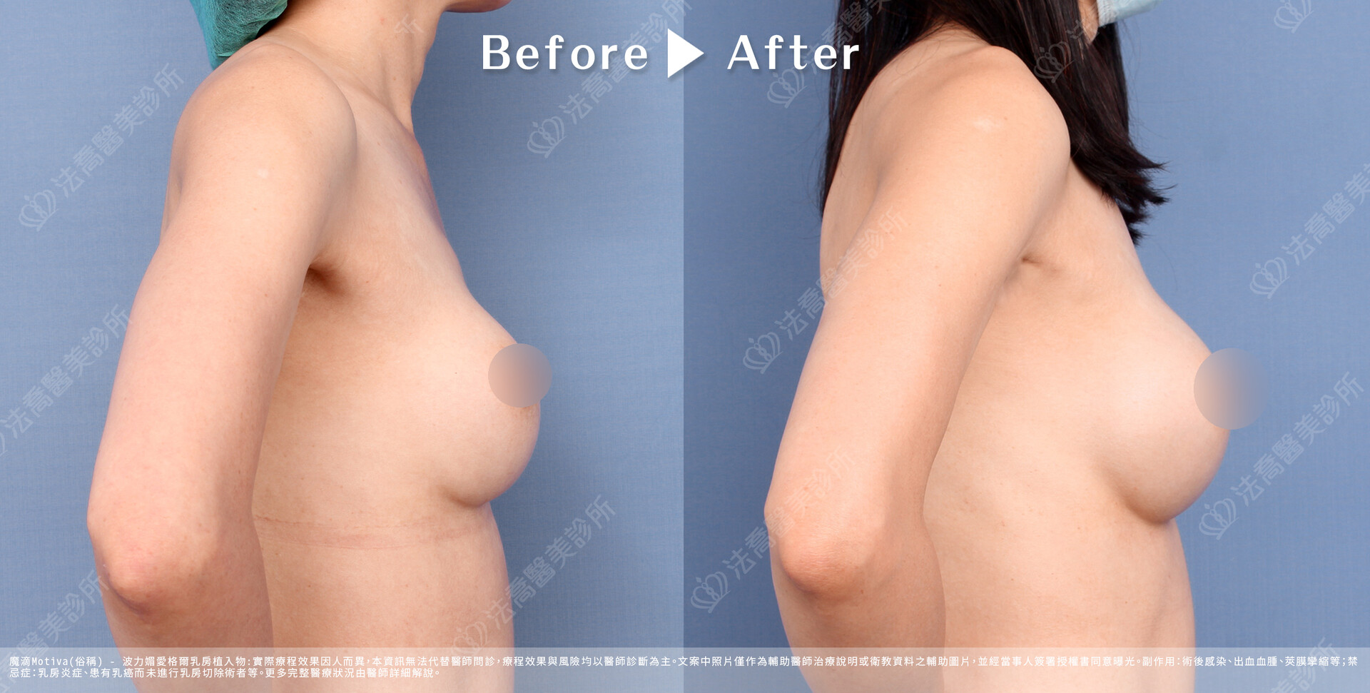 法喬醫美診所,魔滴隆乳