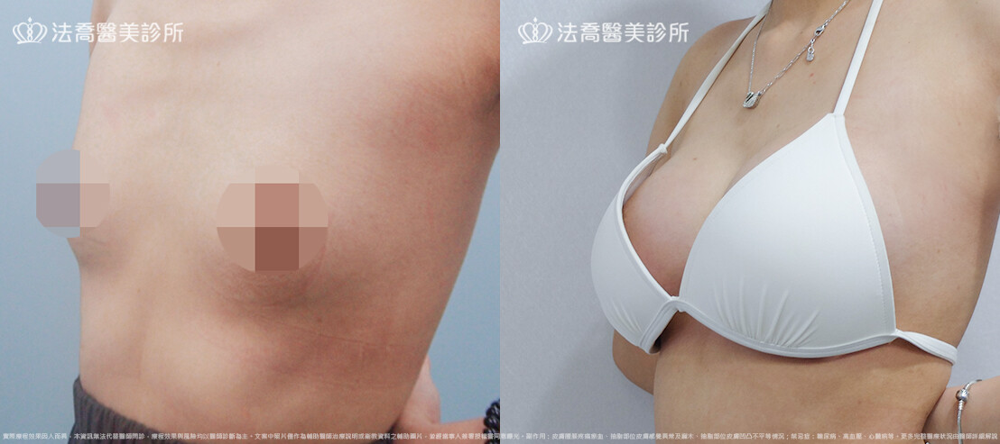 法喬醫美診所,邱浚彥,魔滴隆乳