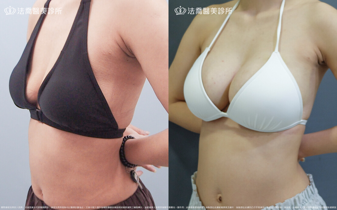 法喬醫美診所,邱浚彥,魔滴隆乳