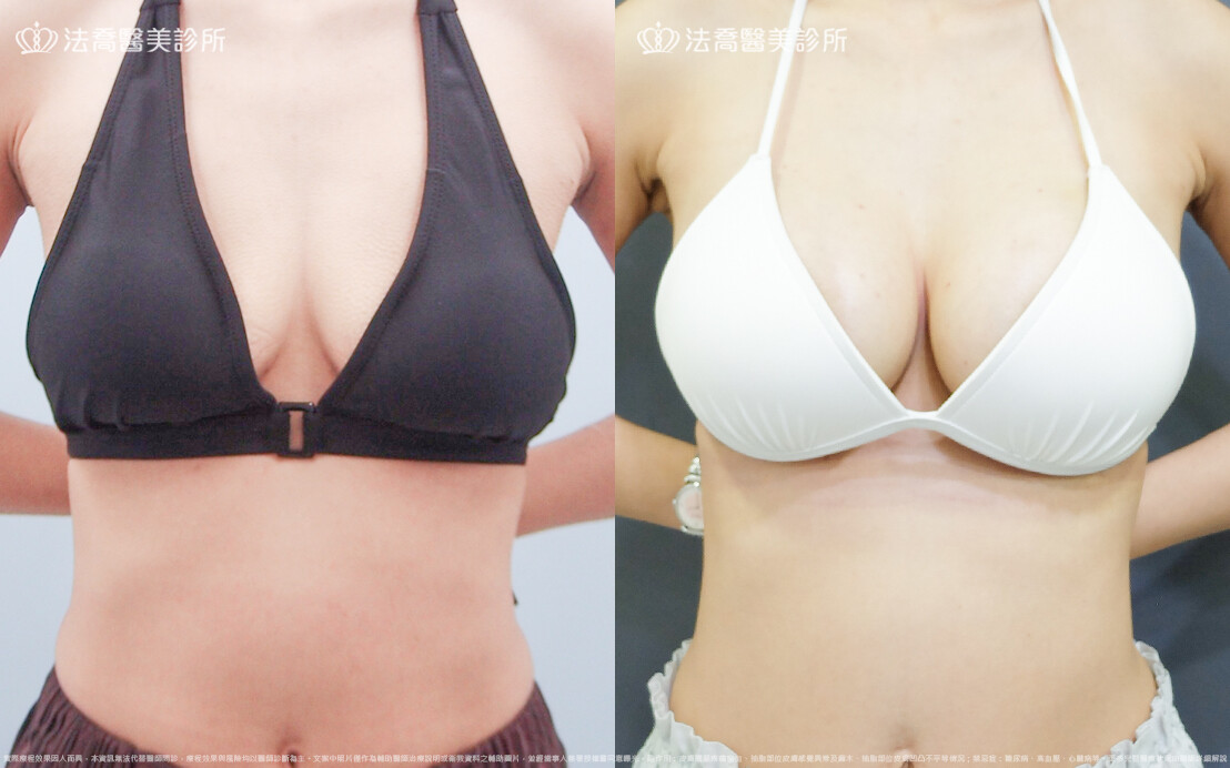 法喬醫美診所,邱浚彥,魔滴隆乳