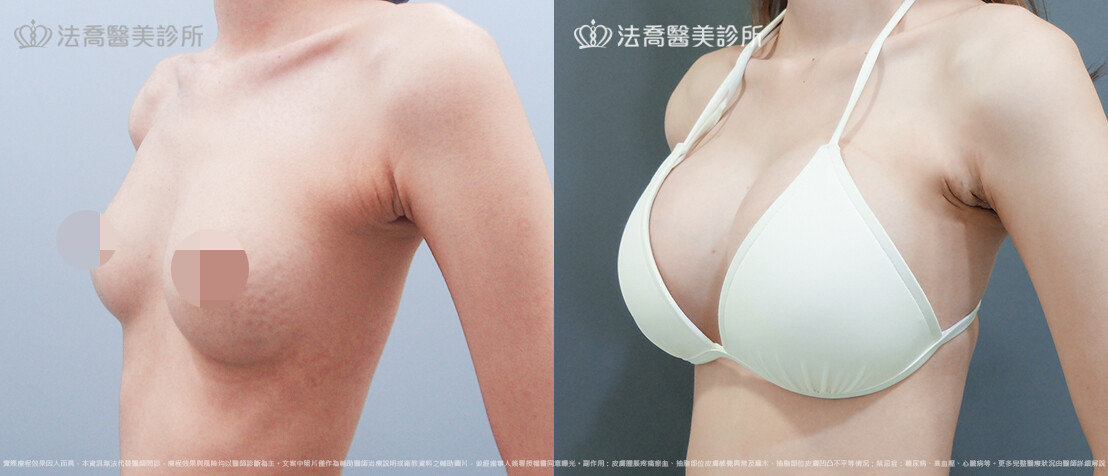 法喬醫美診所,邱浚彥,魔滴隆乳