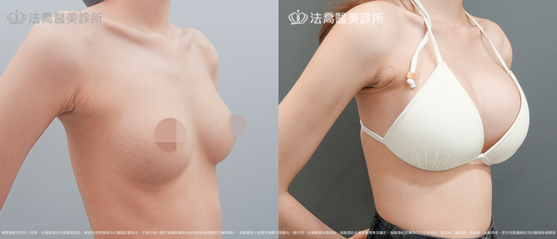 法喬醫美診所,邱浚彥,魔滴隆乳