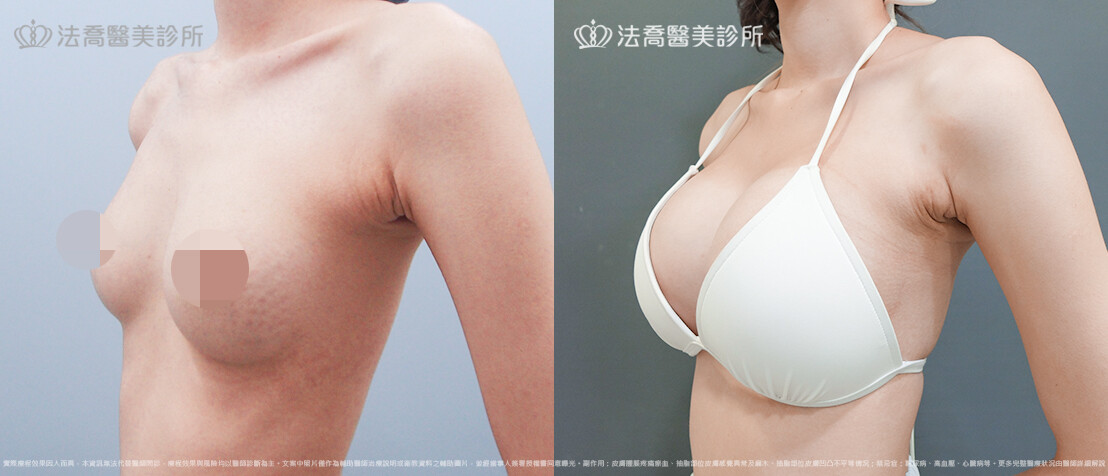 法喬醫美診所,邱浚彥,魔滴隆乳