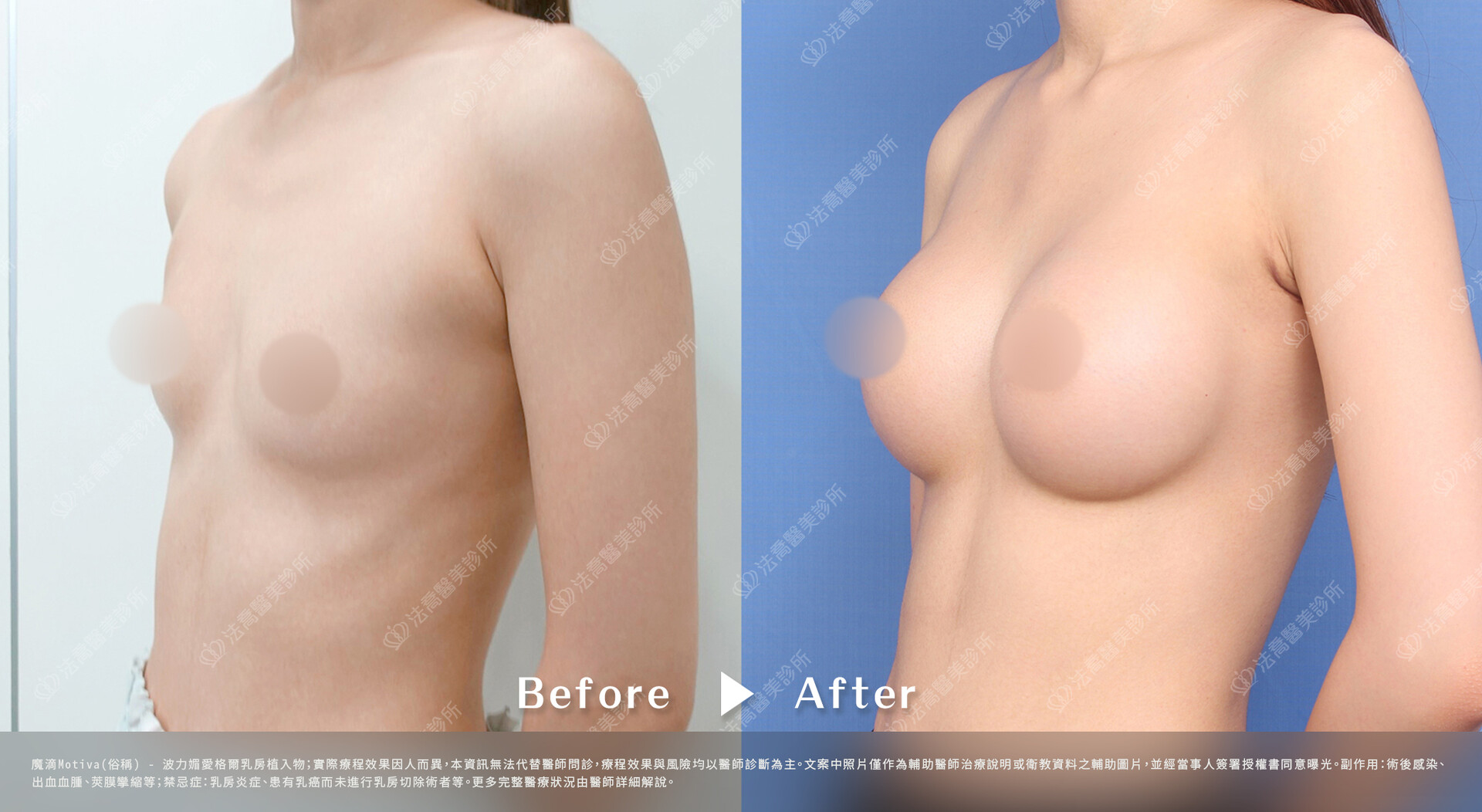 法喬醫美診所,魔滴隆乳