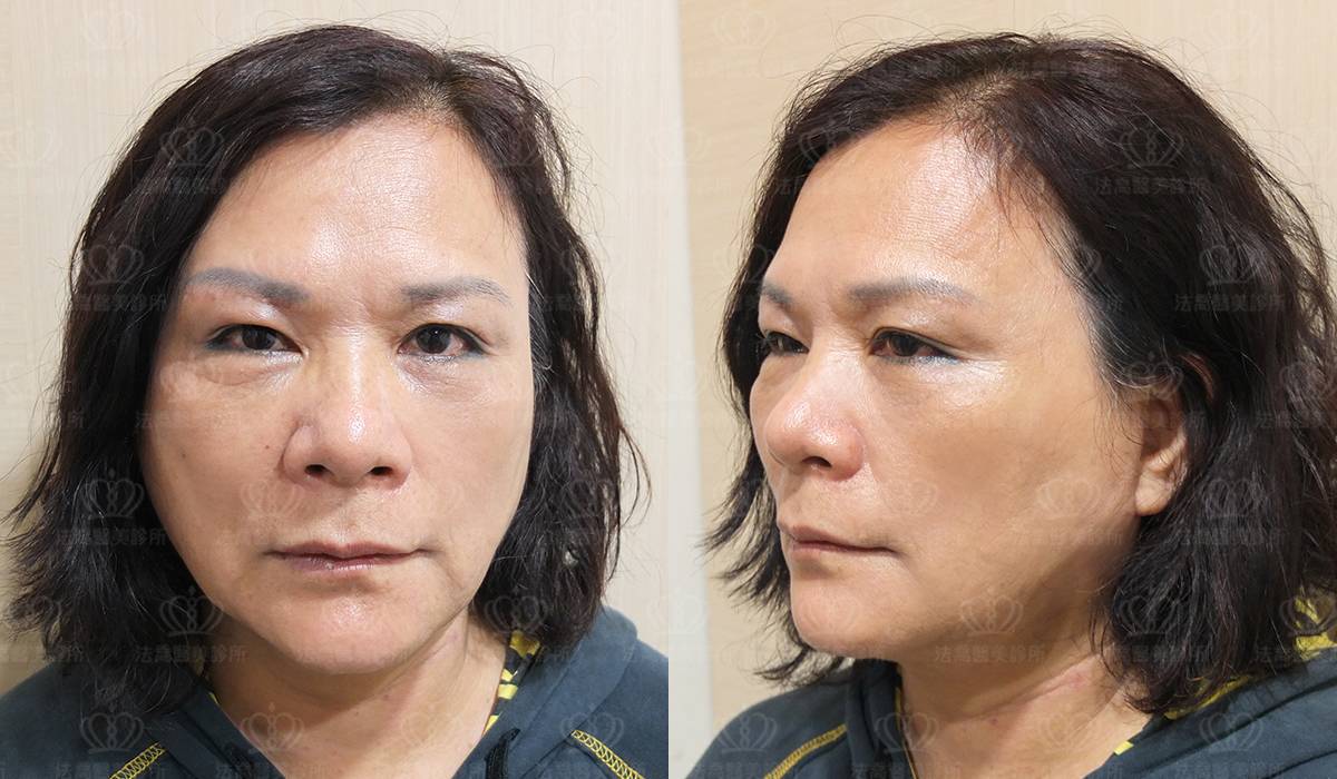 深部筋膜拉皮案例