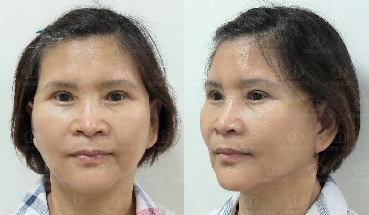 深部筋膜拉皮案例