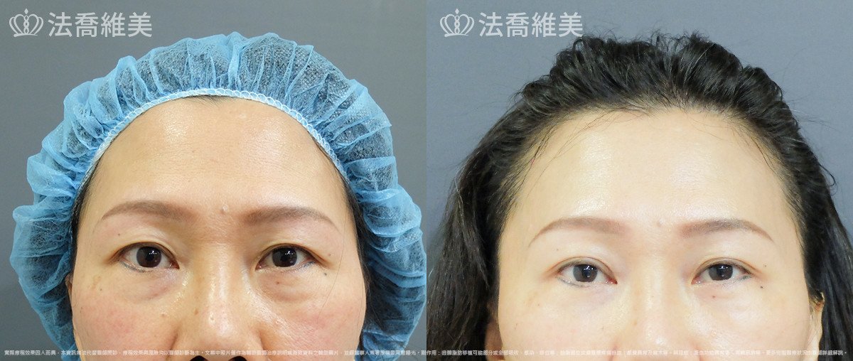 法喬醫美診所,邱浚彥,內視鏡前額五爪拉皮