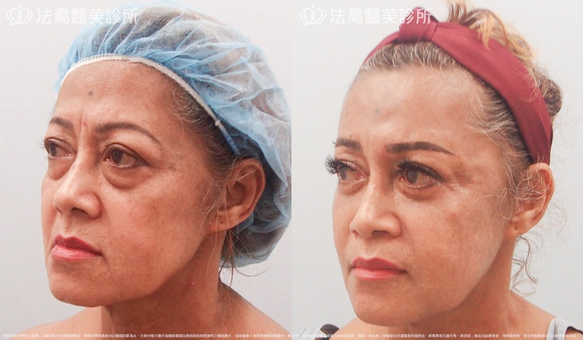 法喬醫美診所,邱浚彥,自體豐全臉