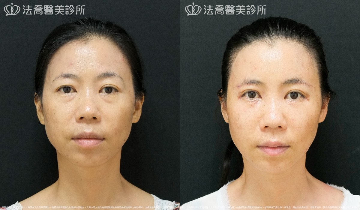 法喬醫美診所,邱浚彥,自體豐全臉