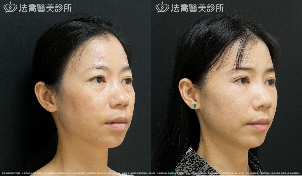 法喬醫美診所,邱浚彥,自體豐全臉