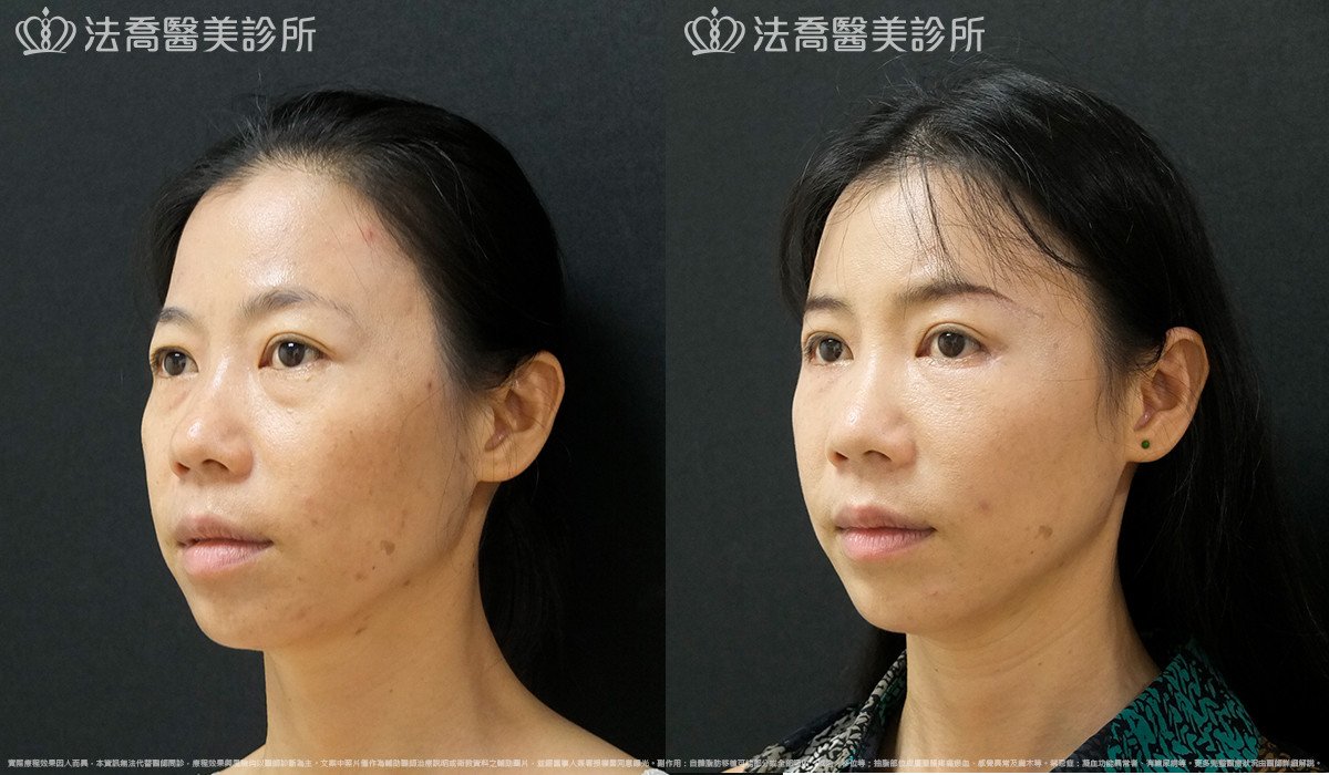 法喬醫美診所,邱浚彥,自體豐全臉