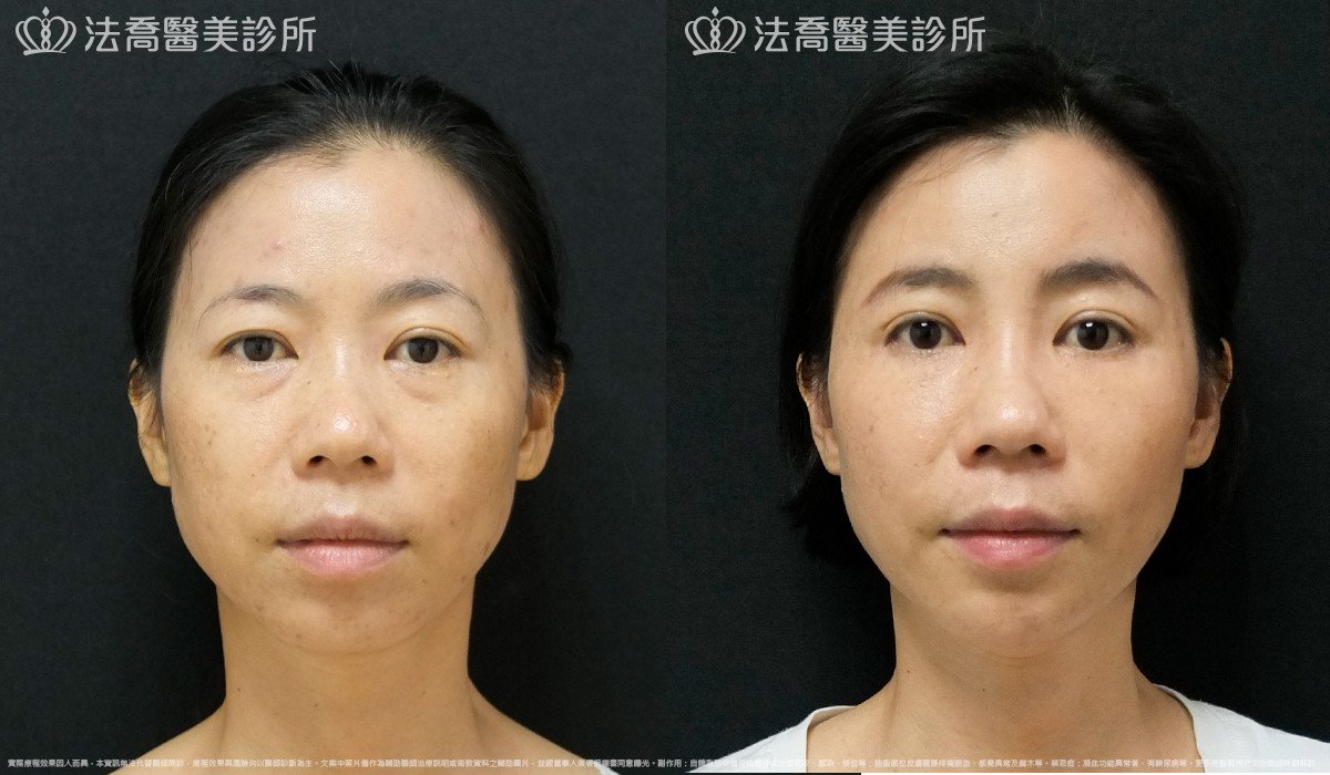 法喬醫美診所,邱浚彥,自體豐全臉