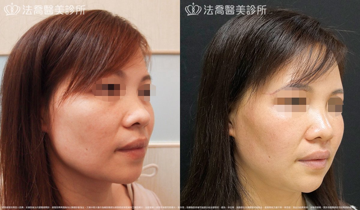 法喬醫美診所,邱浚彥,自體豐全臉