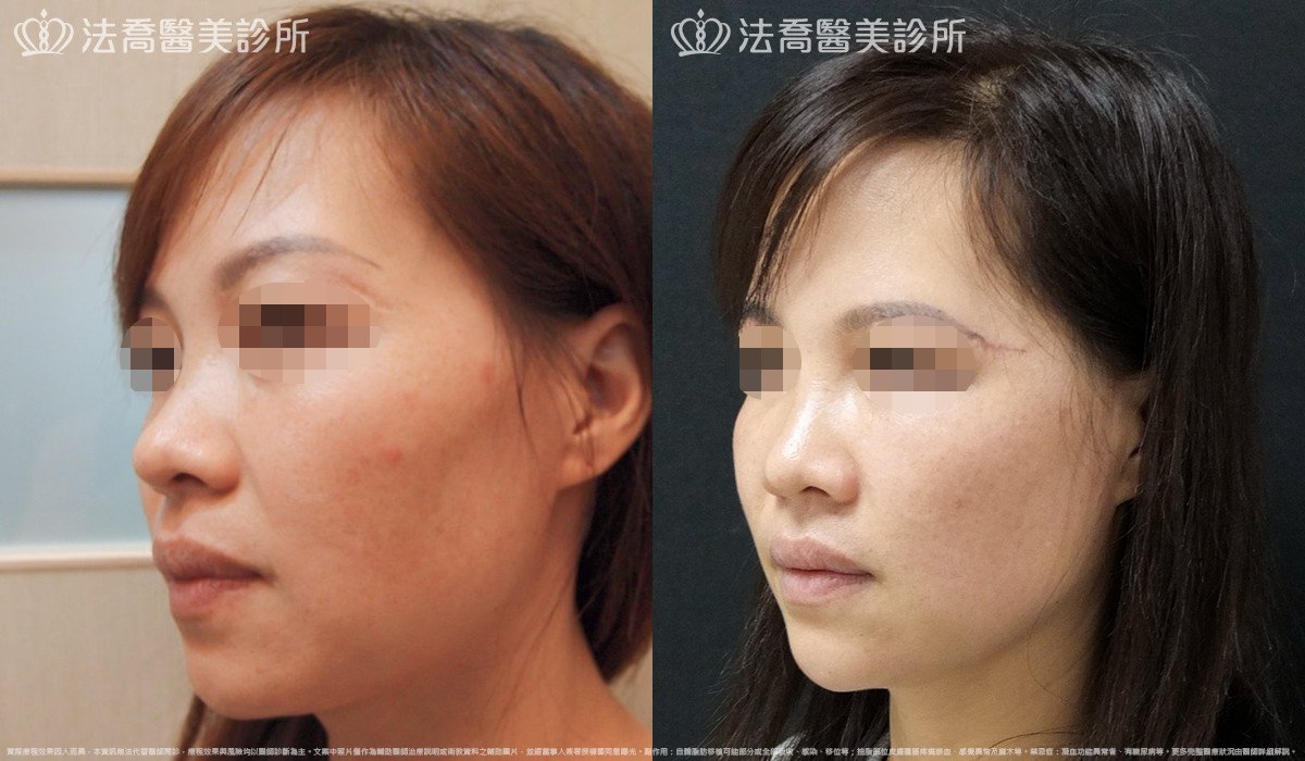 法喬醫美診所,邱浚彥,自體豐全臉