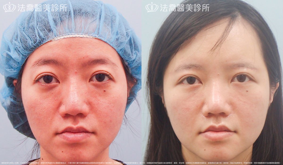 法喬醫美診所,邱浚彥,自體豐全臉