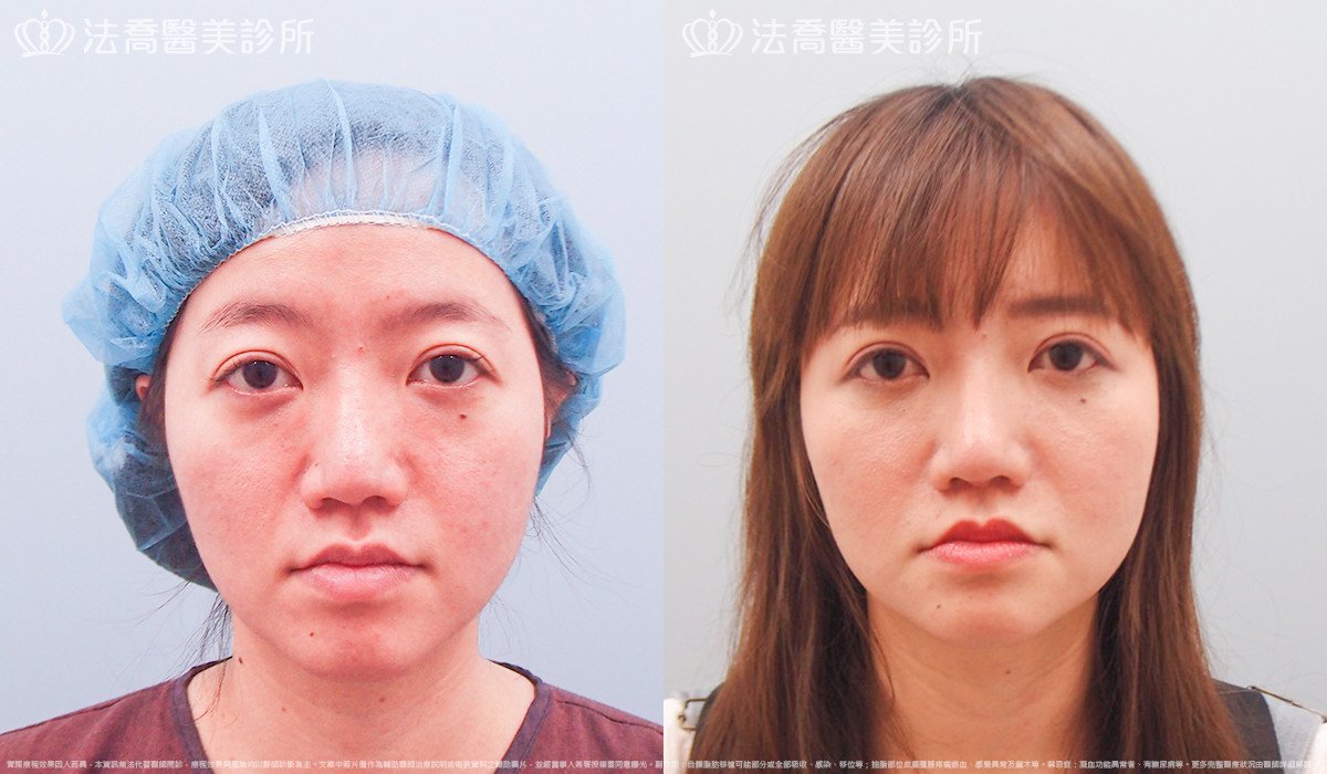 法喬醫美診所,邱浚彥,自體豐全臉