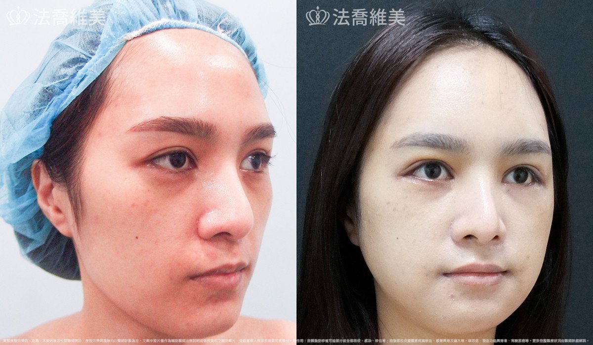 法喬醫美診所,邱浚彥,自體豐全臉