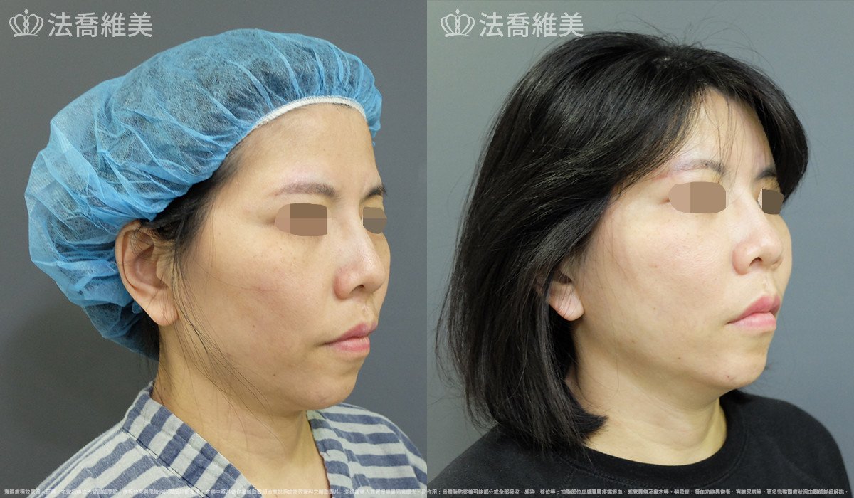 法喬醫美診所,邱浚彥,自體豐全臉