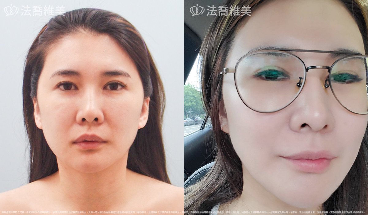 法喬醫美診所,邱浚彥,自體豐全臉