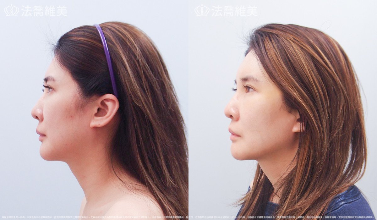 法喬醫美診所,邱浚彥,自體豐全臉